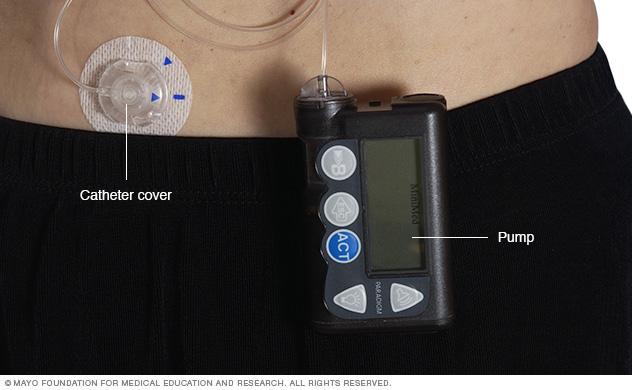 Illustration showing an insulin pump