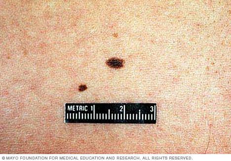Moles