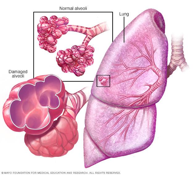 Normal lung tissue and lung tissue damaged by emphysema